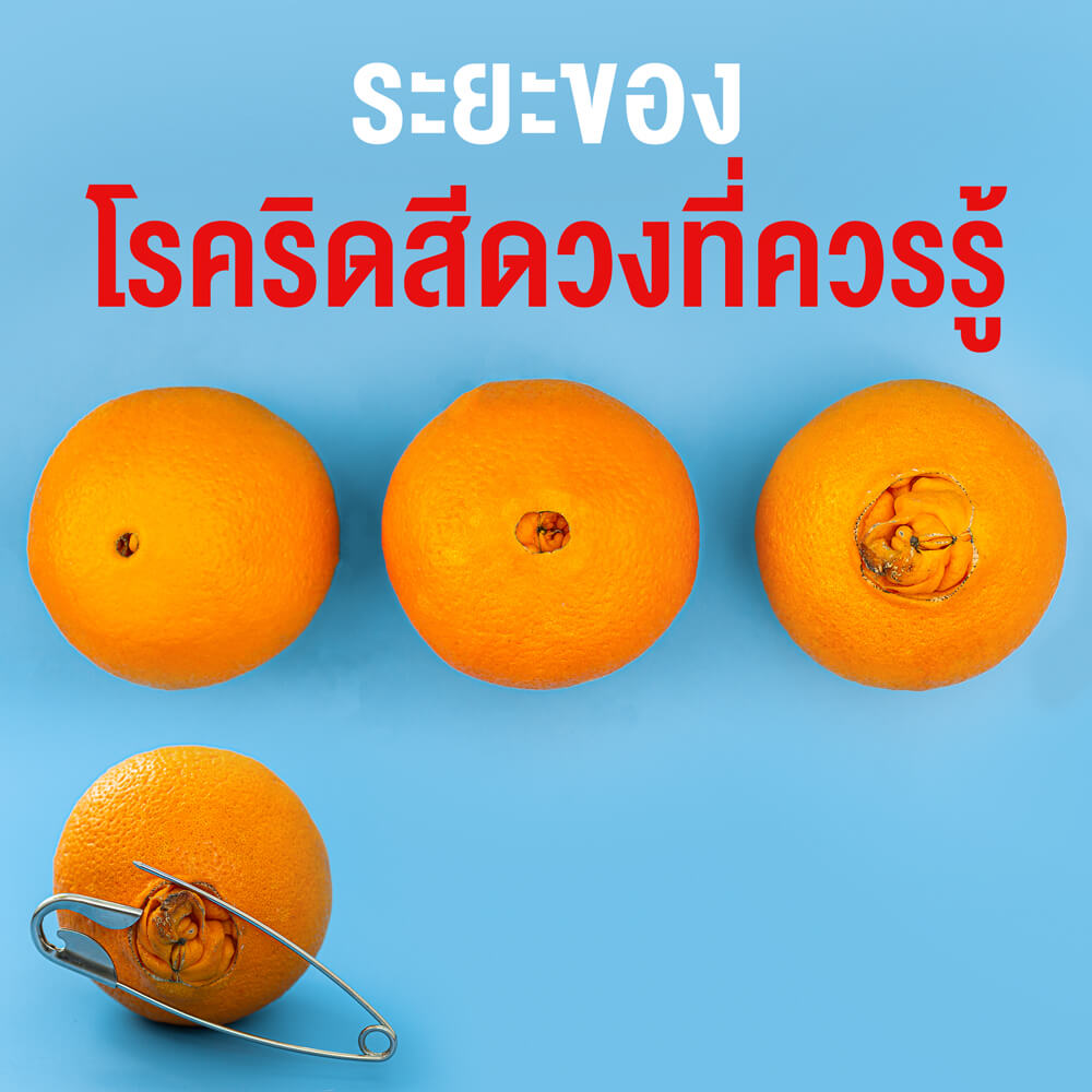 ระยะของโรคริดสีดวง