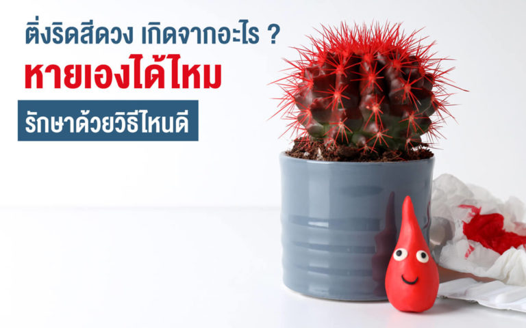 ติ่งริดสีดวง เกิดจากอะไร? หายเองได้ไหม? รักษาด้วยวิธีไหนดี