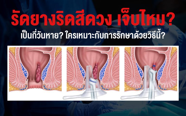 รัดยางริดสีดวง เจ็บไหม? เป็นกี่วันหาย? ใครเหมาะกับการรักษาด้วยวิธีนี้?