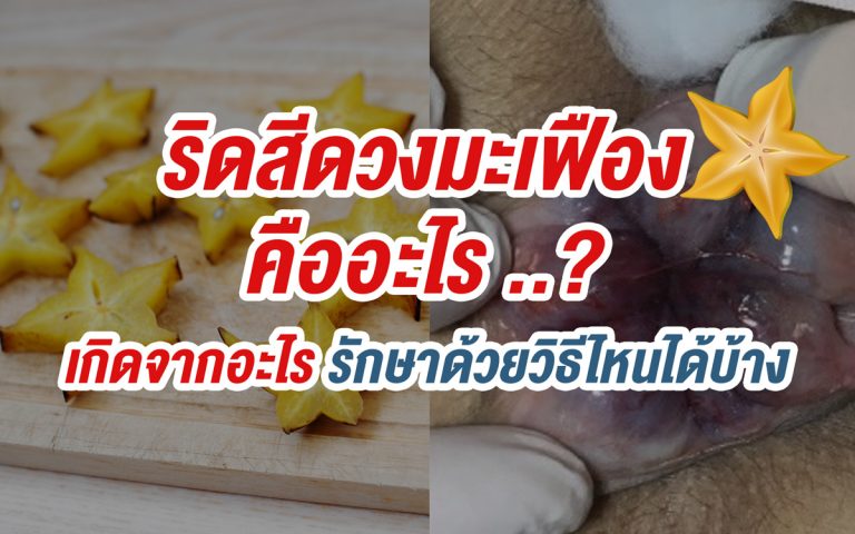 ริดสีดวงกลีบมะเฟือง คืออะไร เกิดจากอะไร รักษาด้วยวิธีไหนได้บ้าง?