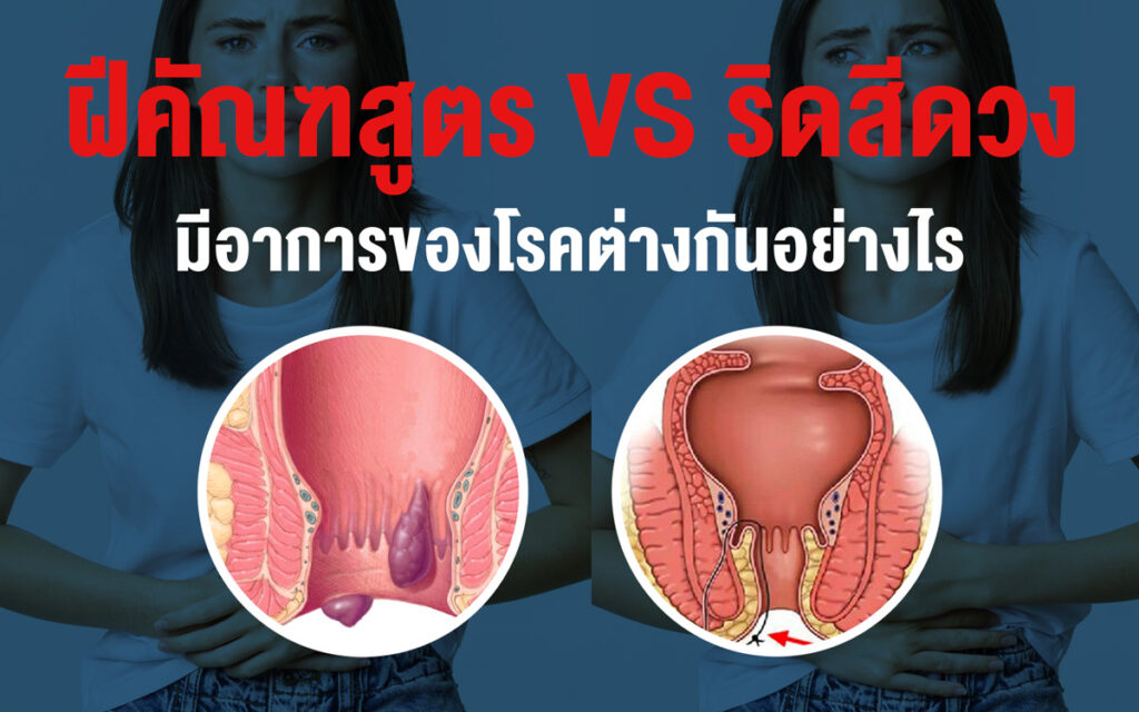 ฝีคัณฑสูตร กับ ริดสีดวง