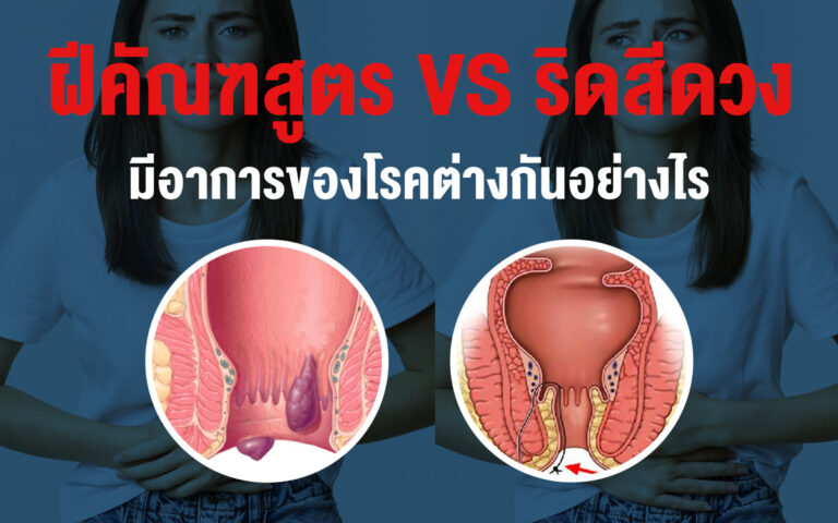 เปรียบเทียบอาการ ฝีคัณฑสูตร กับ ริดสีดวง ต่างกันอย่างไร?